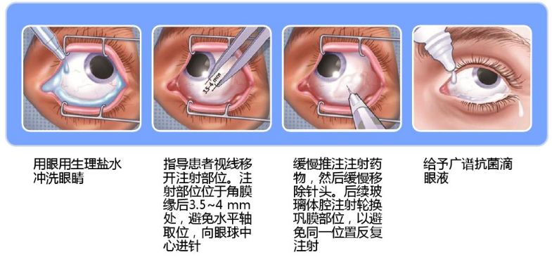 球结膜注射图解图片